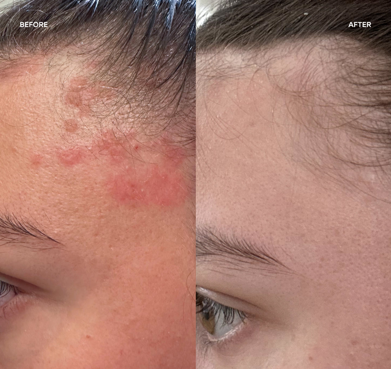 before and after image showing psoriasis healing